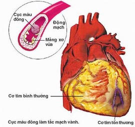 Điều trị bệnh tim mạch hoàn hảo tại PIYAVATE tại Thái Lan