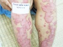 Tp. Hồ Chí Minh: Bệnh Vẩy Nến -Thuốc Chữa Bệnh Vẩy Nến CL1161035P4