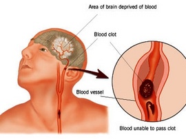 Bệnh Tai biến mạch máu não - Xuất huyết não và thuốc Đặc Hiệu