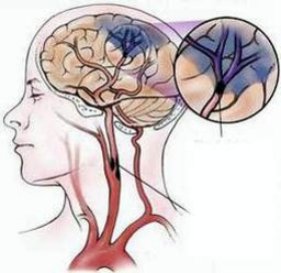 Bệnh Tai biến mạch máu não chuẩn đoán và điều trị