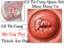 Tp. Hà Nội: Viêm cổ tử cung là gì? dấu hiệu nhận biết ? CL1208186