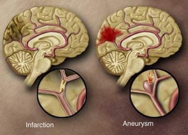 Phân loại tai biến mạch máu não và hướng điều trị