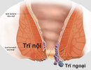 Tp. Hồ Chí Minh: Trĩ nội ,Trĩ ngoại Thuốc chữa bệnh trĩ Ayulax CL1453519P8