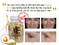 [1] Trước và sau sử dụng Tinh chất - Viên serum Ginseng Skin Oil