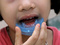 [2] Dụng cụ chỉnh răng cho trẻ em