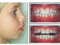 [3] Dụng cụ chỉnh răng cho trẻ em