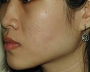 Tp. Hồ Chí Minh: Kem Scar Esthetique trị sẹo lõm, sẹo thâm, sẹo rỗ CL1452368