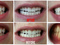 [2] Hệ thống làm trắng răng Platinum Dental Whitening System