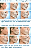 Tp. Hồ Chí Minh: Phẫu thuật chỉnh hình hàm răng hô có phức tạp? CL1609792P10