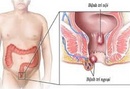 Tp. Hồ Chí Minh: Cách xử lý bệnh trĩ hiệu quả hàng ngày CL1684505P3
