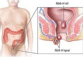 Cách xử lý bệnh trĩ hiệu quả hàng ngày