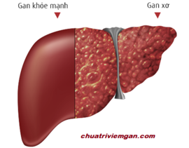 Phương pháp chữa xơ gan cổ trướng bằng thuốc nam hiệu quả